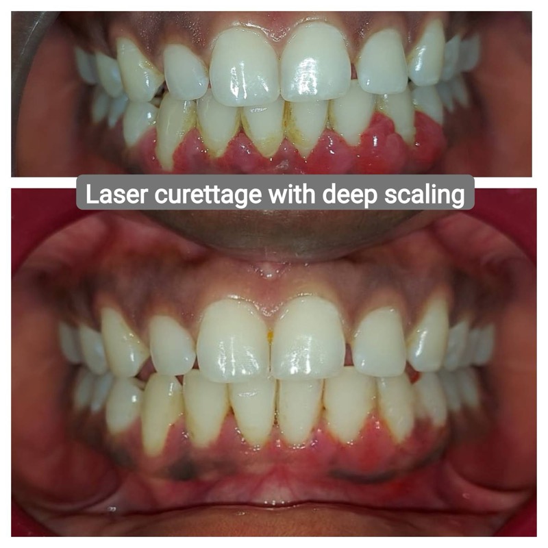 Patient case - before and after