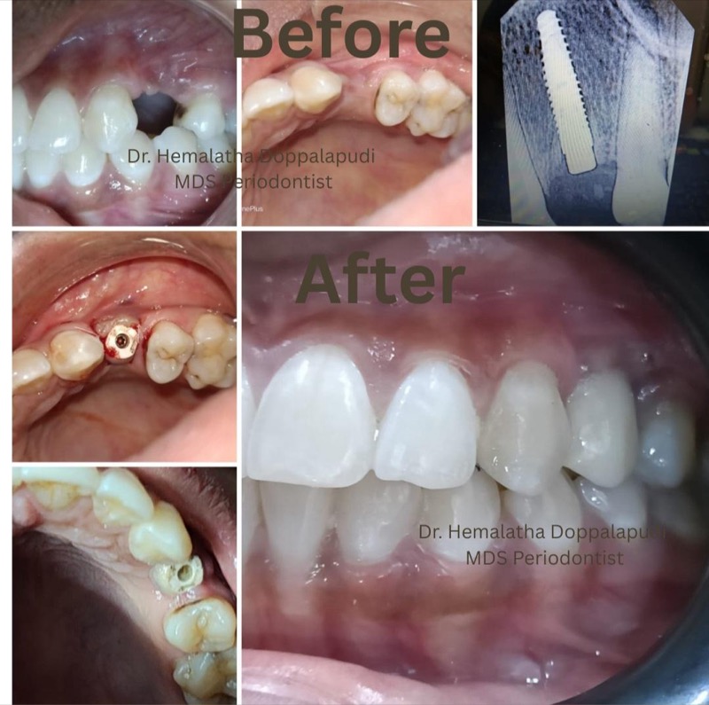 Single implant case - before and after